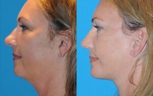 Jawline Enhancement