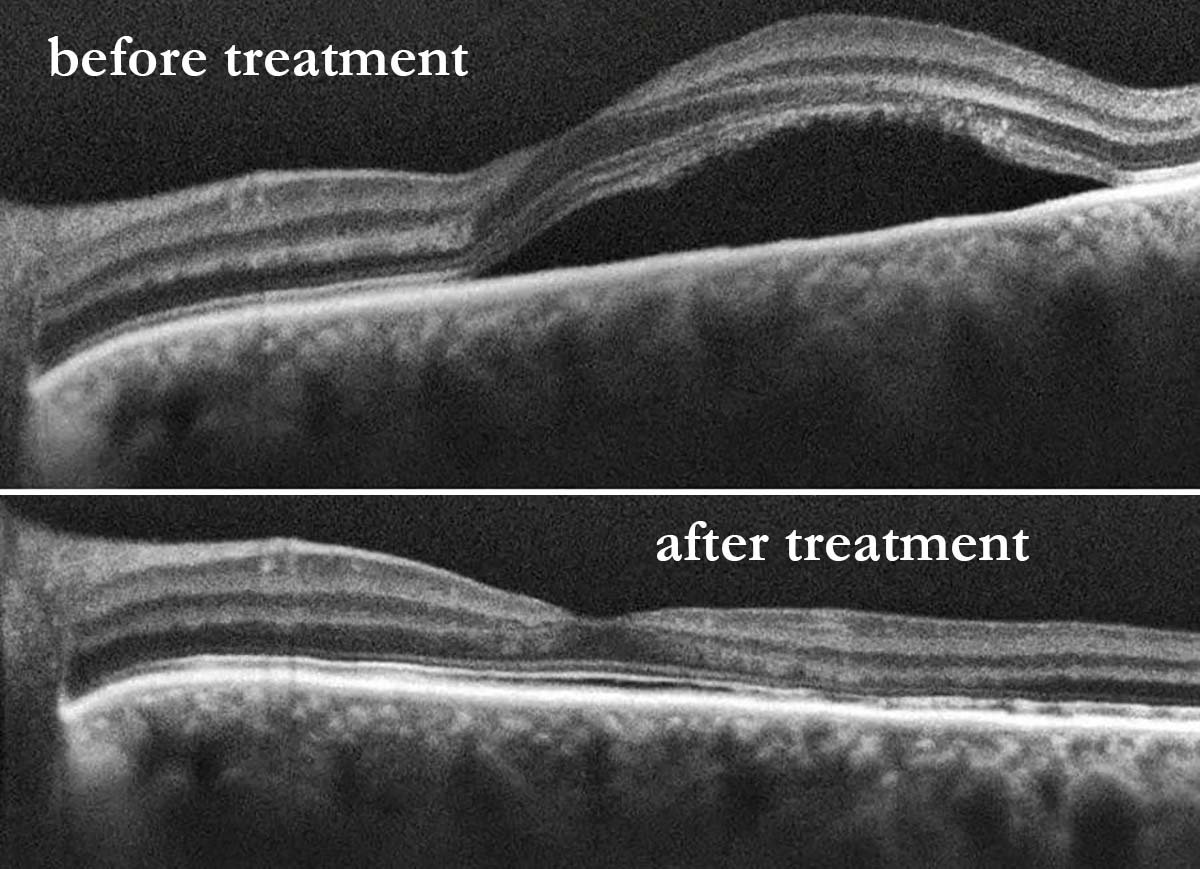 central serous retinopathy